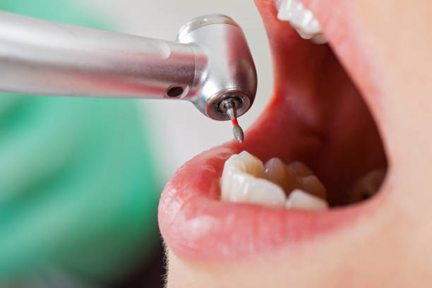Best Emergency Wisdom Teeth Removal in Agua Dulce, TX